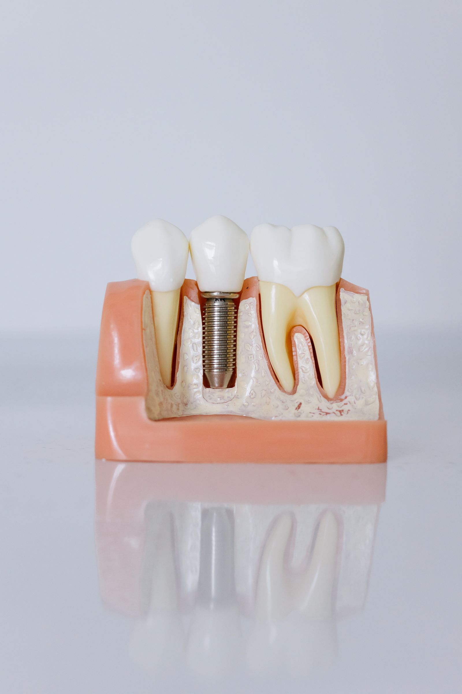 Dental implant prosthetic model